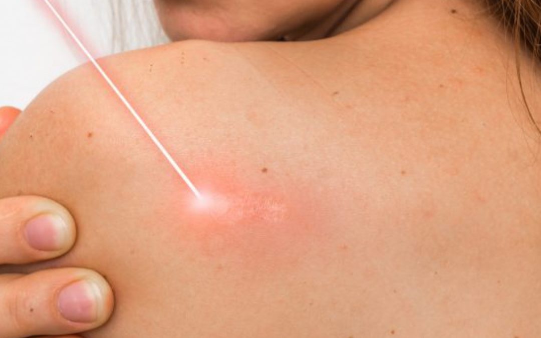 Jak można uniknąć laserowego usuwania blizn?